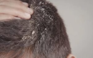 Choose the Right Exfoliation Method