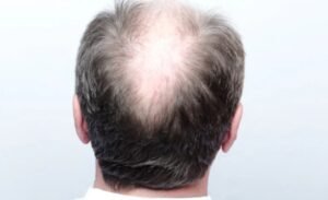 Soothe the Scalp After Shaving