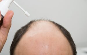 Top Bald-Scalp Moisturizers